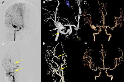 Internal Maxillary Artery-Radial Artery-Middle Cerebral Artery Bypass and STA-MCA Bypass for the Treatment of Complex Middle Cerebral Artery Bifurcation Aneurysm: A Case Report